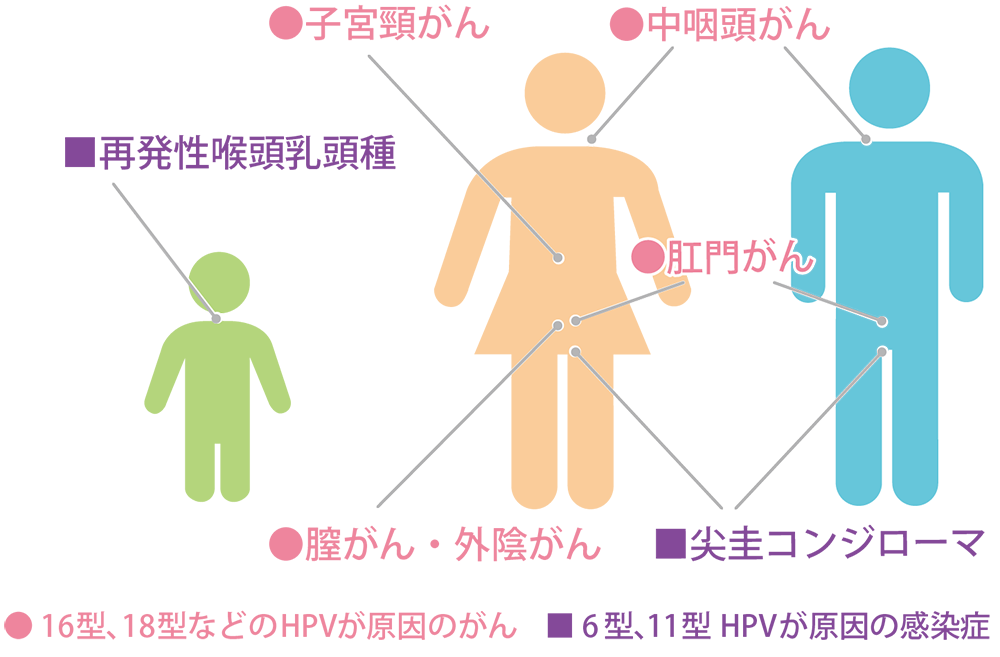 16型、18型などのHPVが原因のがんは、「子宮頸がん、中咽頭がん、肛門がん、膣がん・外陰がん」です。6型、11型HPVが原因の感染症は「再発性喉頭乳頭種、尖圭コンジローマ」です。