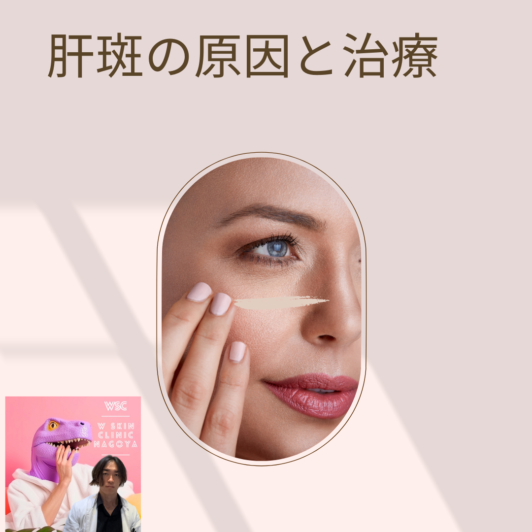 肝斑ができる原因、肝斑治療に有効な内服、美容施術について、名古屋の美容皮膚科医が解説